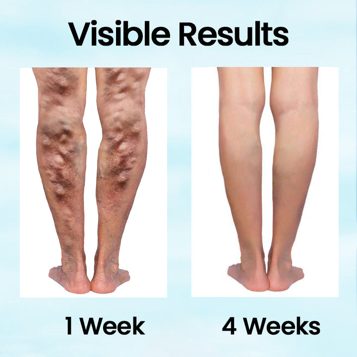 Ceoerty™ VeinMist Varicose Vein Spray