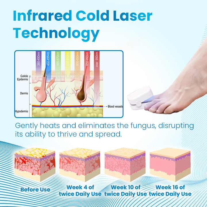 Ceoerty™ Antifungal Light Therapy Toenail Device